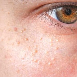 میلیا چیست و چه روش های درمانی دارد؟